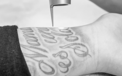 Laser Tattoo Removal