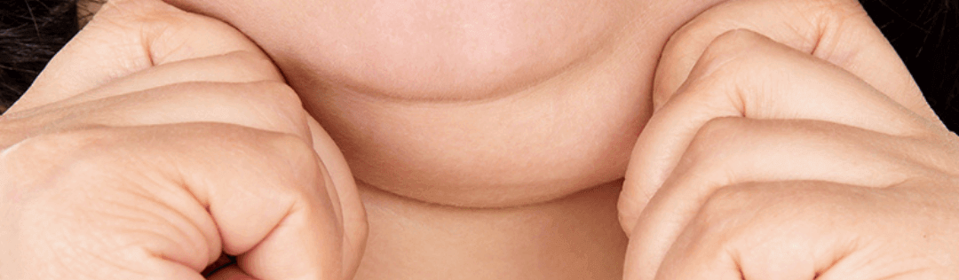 All About Kybella