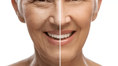 Skin Rejuvenation