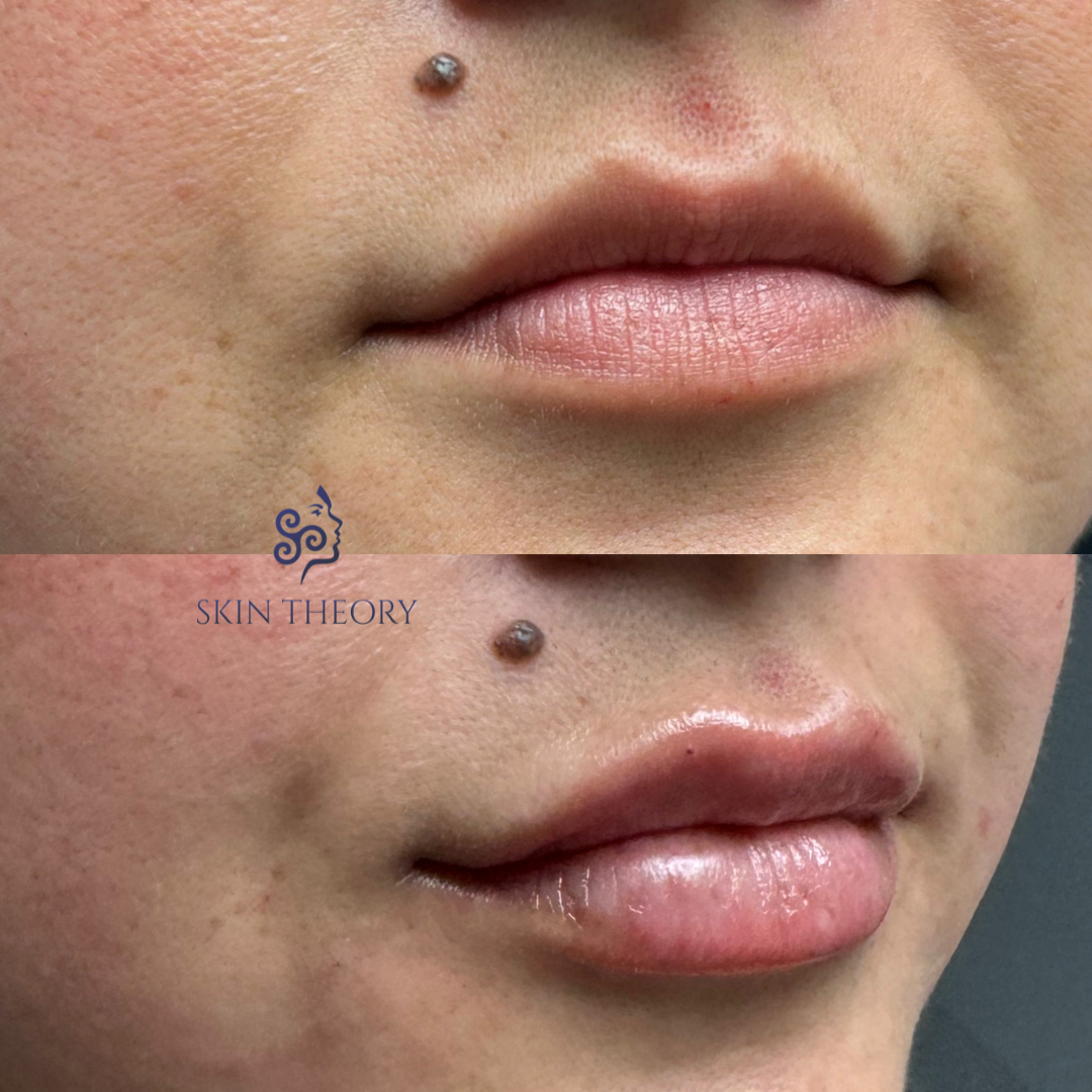 Before-and-After-RHA-3-for-Lips-1