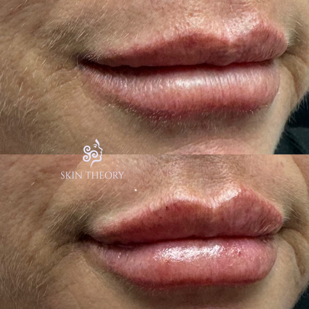 Before-and-After-RHA-3-for-Lips-2