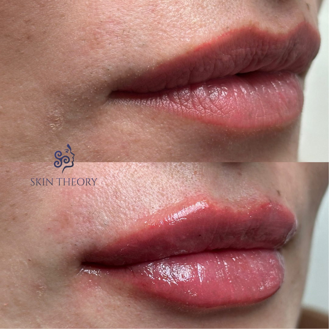 Before-and-After-RHA-for-Lips-3