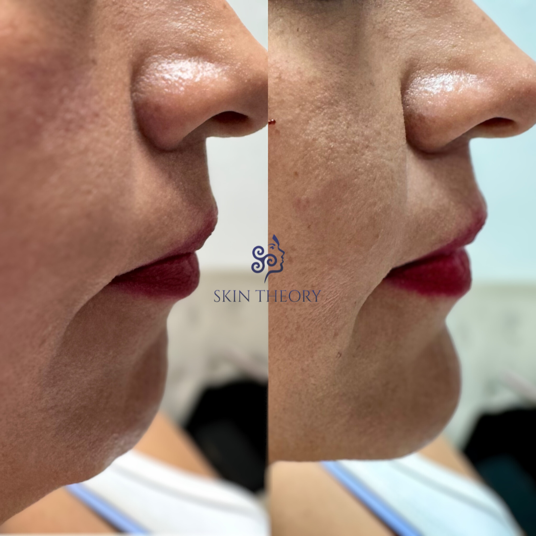 Before-and-After-Radiesse-Chin-Filler