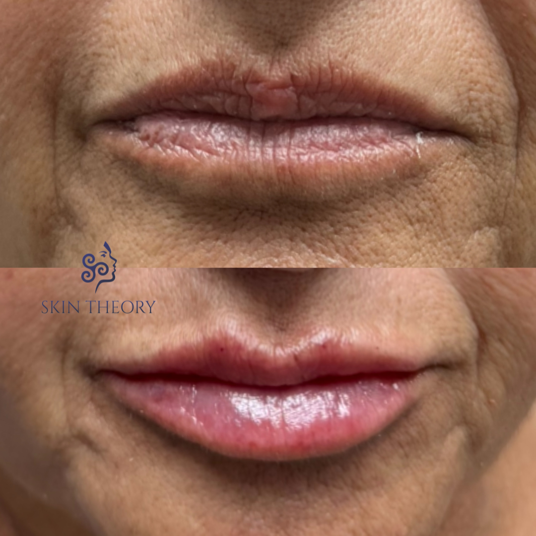 RHA redensity for lips