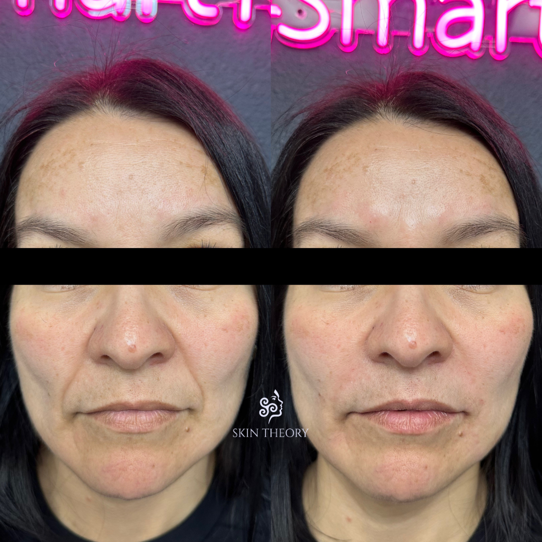 Skin-and-Derm-Theory-Before-and-After-RHA-for-Frown-Lines-1