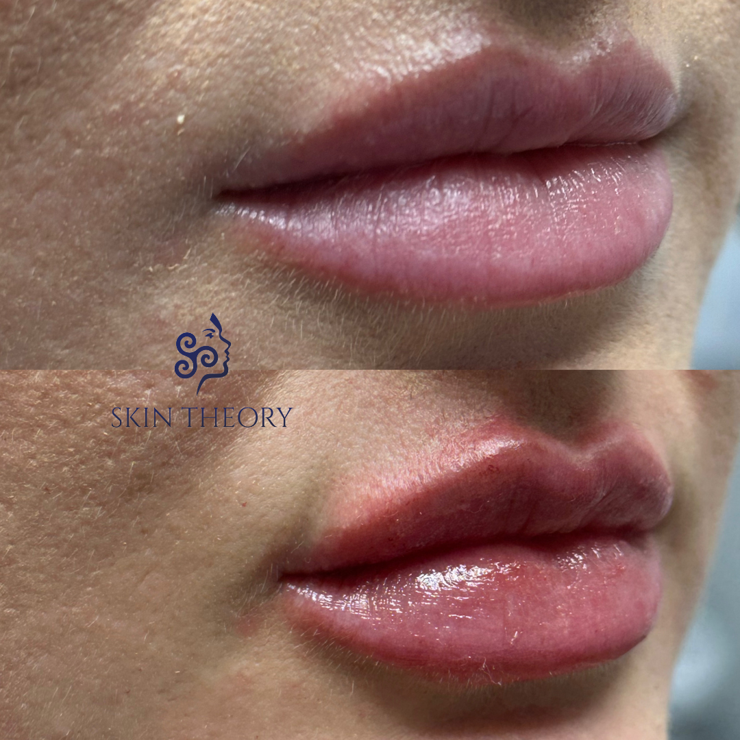 Skin-and-Derm-Theory-Before-and-After-RHA-for-Lips-1