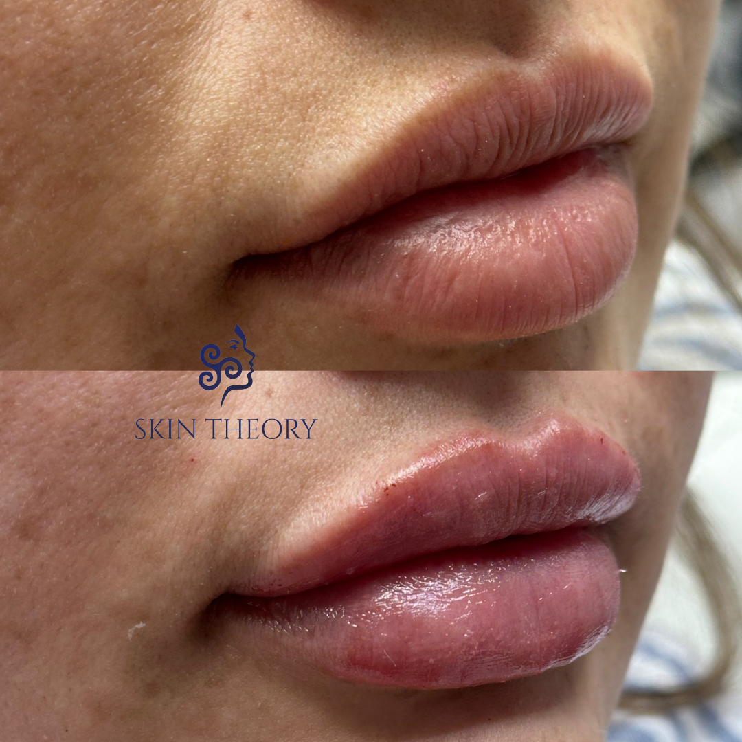 Skin-and-Derm-Theory-Before-and-After-RHA-for-Lips-2