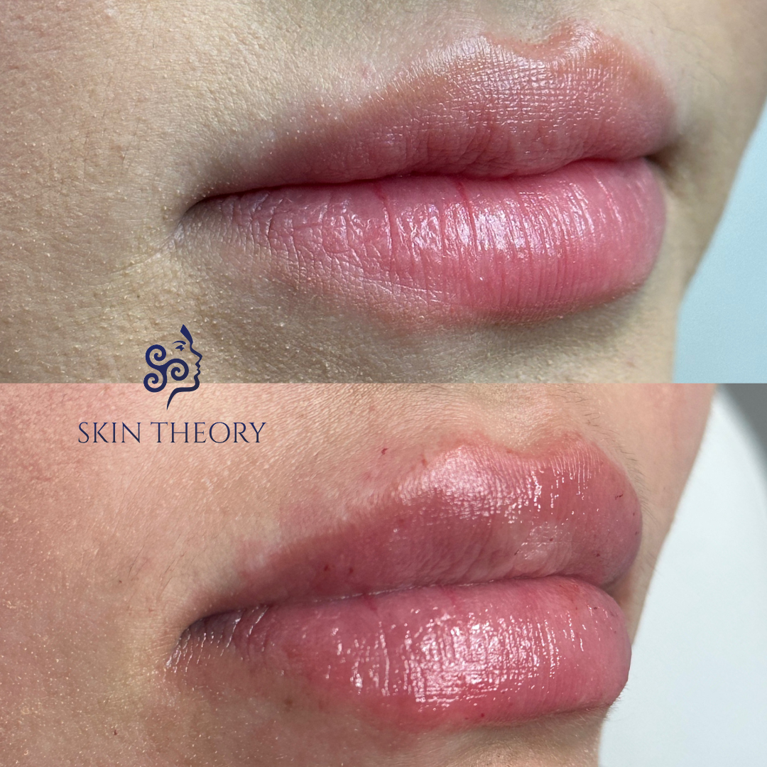 Skin-and-Derm-Theory-Before-and-After-RHA-for-Lips-3