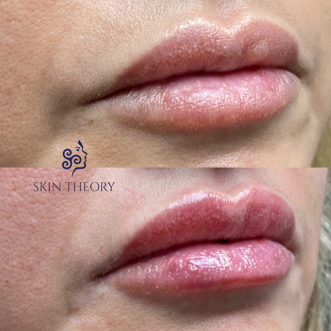 Skin-and-Derm-Theory-Before-and-After-RHA-for-Lips-4