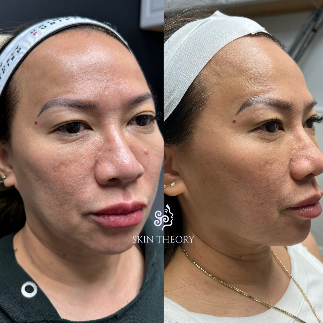 Skin-and-Derm-Theory-Before-and-After-Ultra-Laser-for-Skin-Texture-After-2-sessions-1