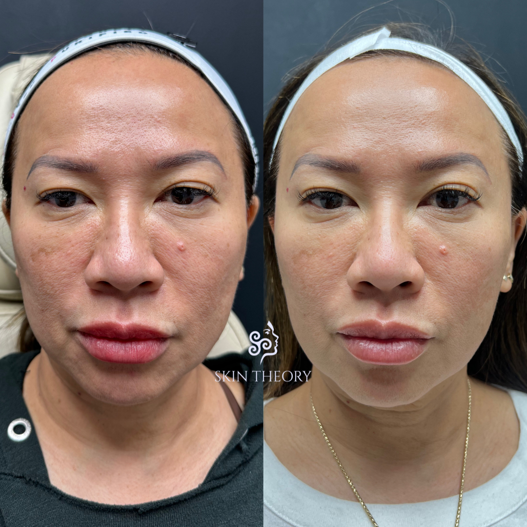 Skin-and-Derm-Theory-Before-and-After-Ultra-Laser-for-Skin-Texture-After-2-sessions-2