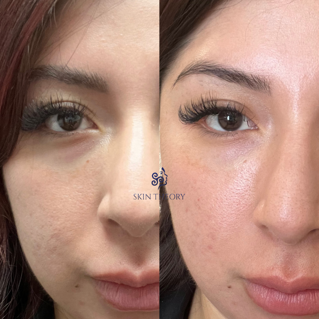 Skin-and-Derm Theory-Before-and-after-Belotero-for-under-eyes-March-2024