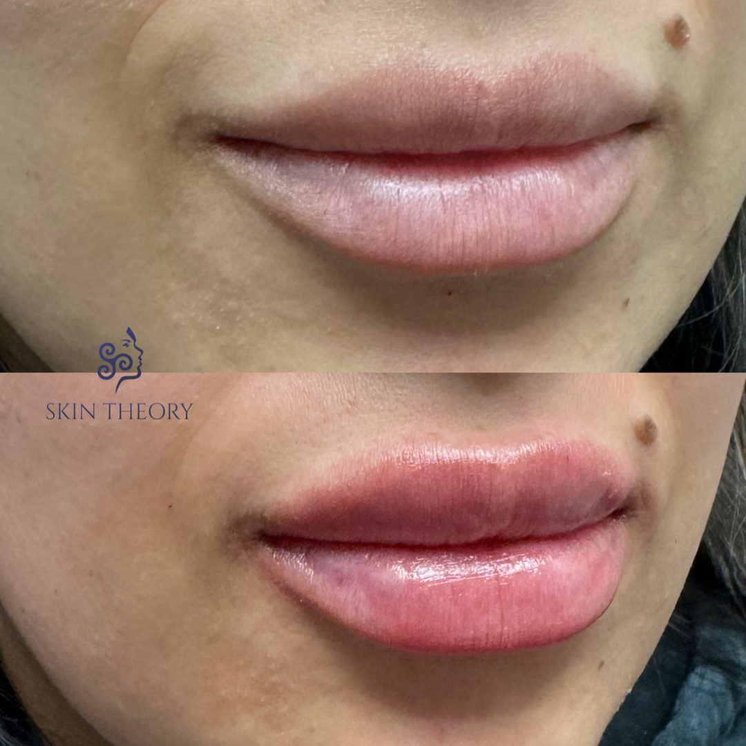 Skin-and-Derm Theory-Before-and-after-RHA-for-lips-1 5-syringe-April-2024