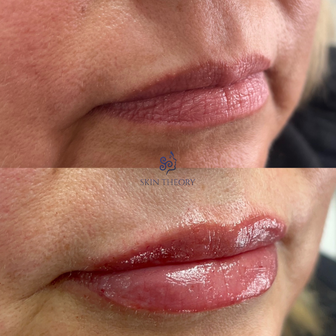 Skin-and-Derm Theory-Before-and-after-RHA-for-lips-April-2024-1