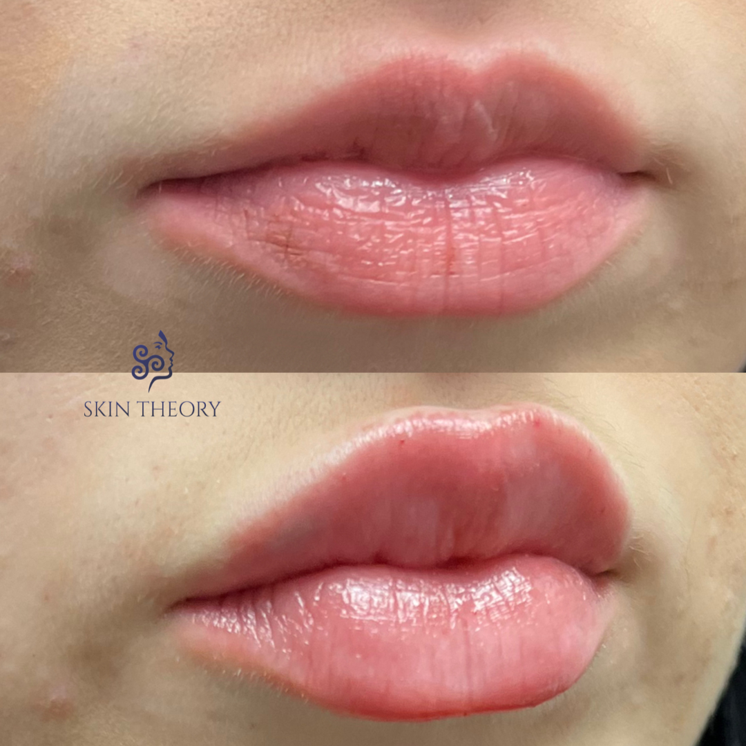 Skin-and-Derm Theory-Before-and-after-RHA-for-lips-April-2024-2