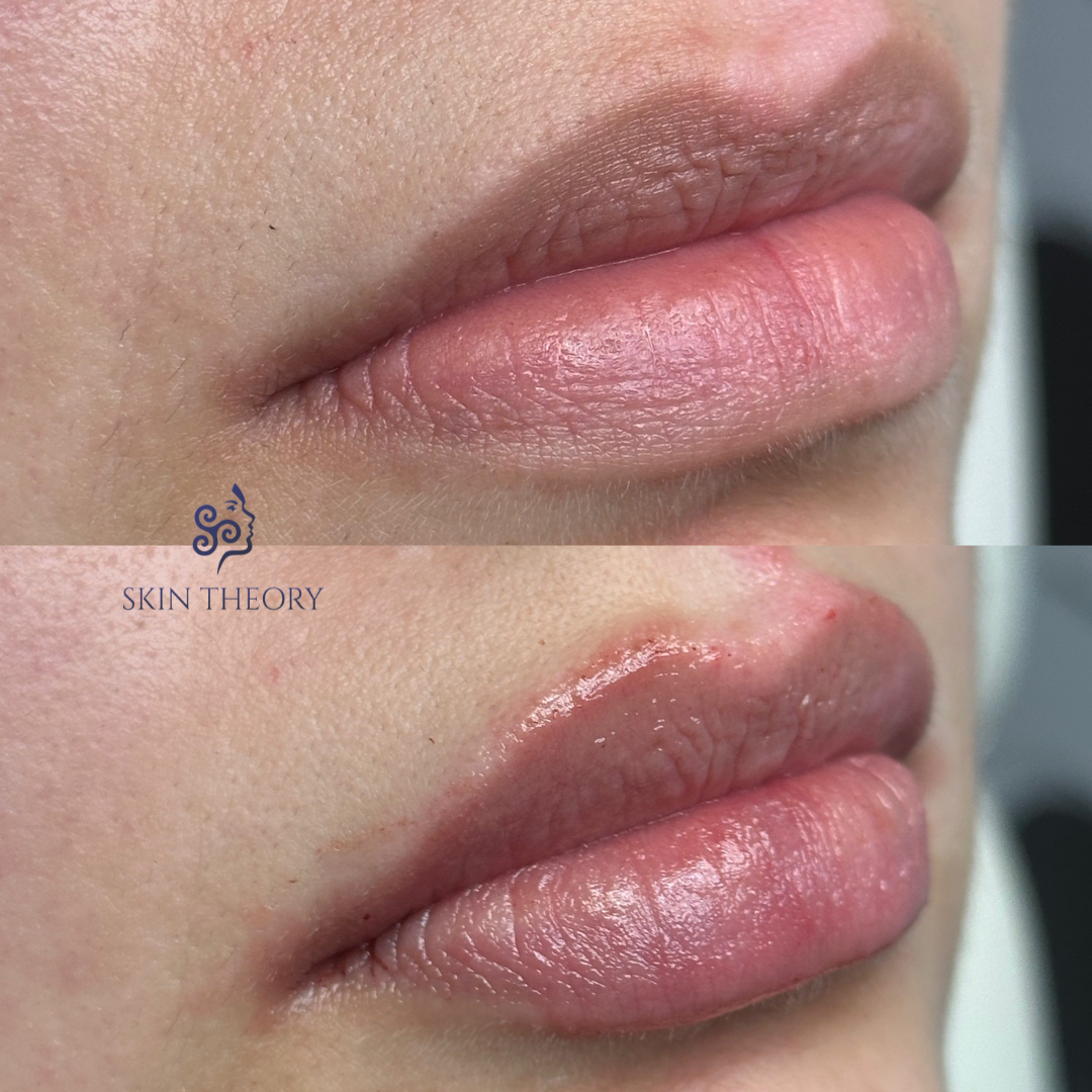 Skin-and-Derm Theory-Before-and-after-RHA-for-lips-April-2024-3