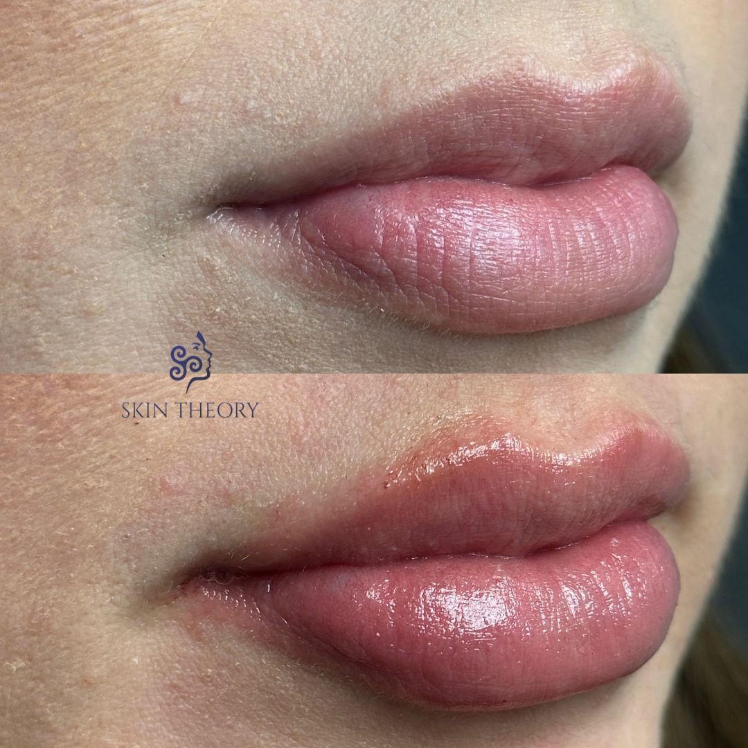 Skin-and-Derm Theory-Before-and-after-RHA-for-lips-April-2024-4