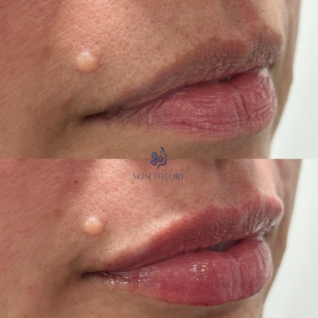 Skin-and-Derm Theory-Before-and-after-RHA-for-lips-April-2024-5