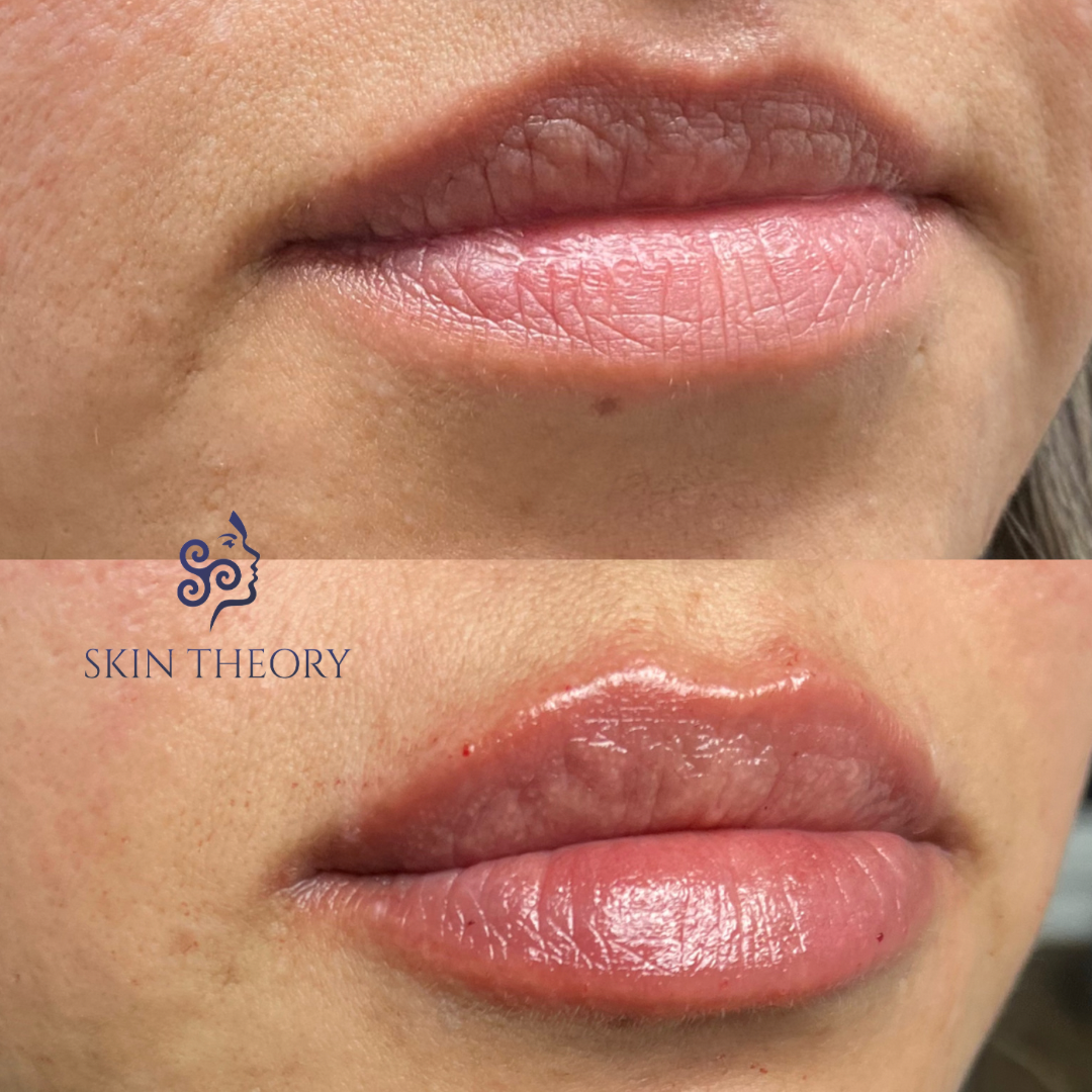 Skin-and-Derm Theory-Before-and-after-RHA-for-lips-April-2024-6