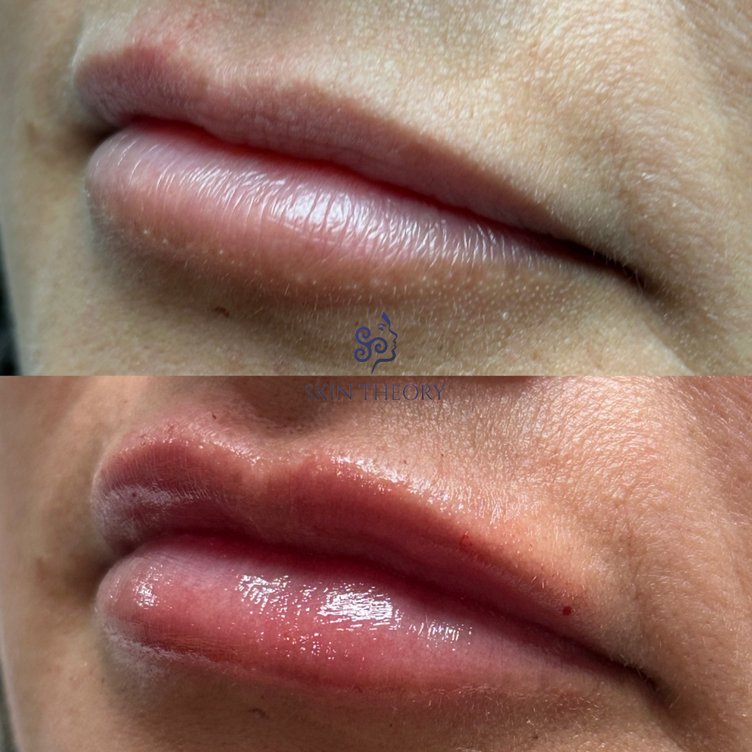 Skin-and-Derm Theory-Before-and-after-RHA-for-lips-March-2024-1