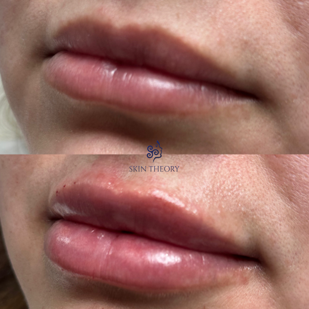 Skin-and-Derm Theory-Before-and-after-RHA-for-lips-March-2024-2