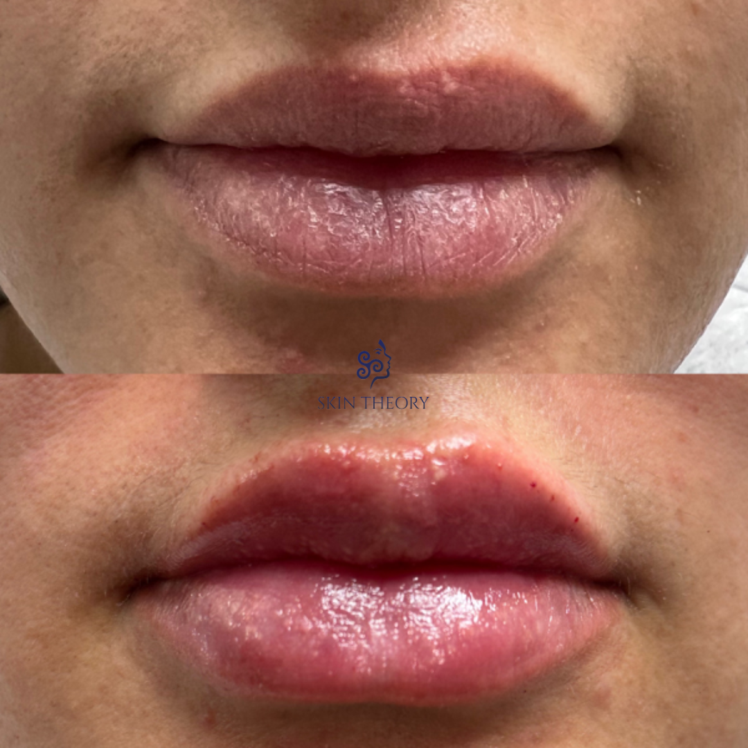 Skin-and-Derm Theory-Before-and-after-RHA-for-lips-March-2024-3