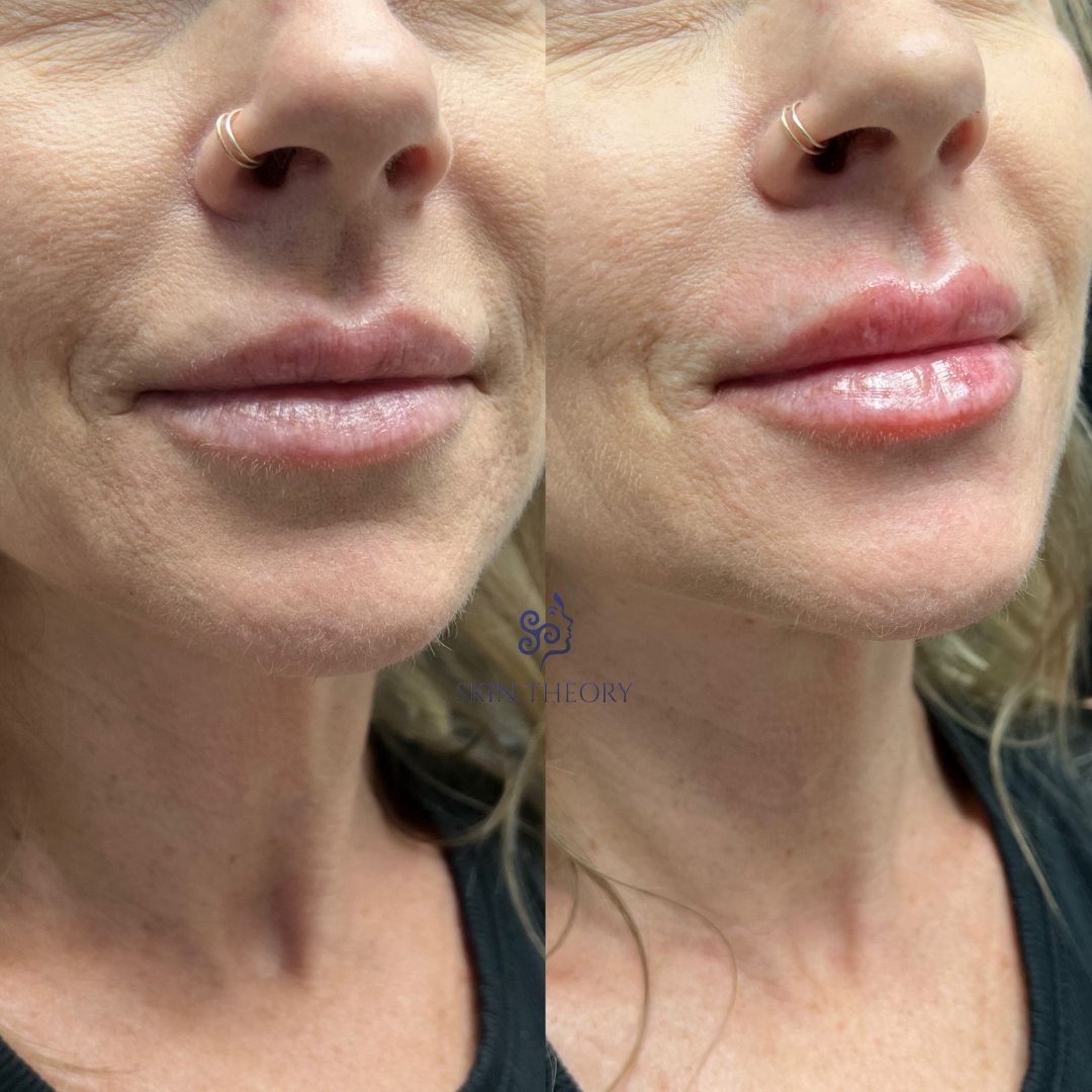 Skin-and-Derm Theory-Before-and-after-RHA-for-lips-half-syringe-April-2024-7