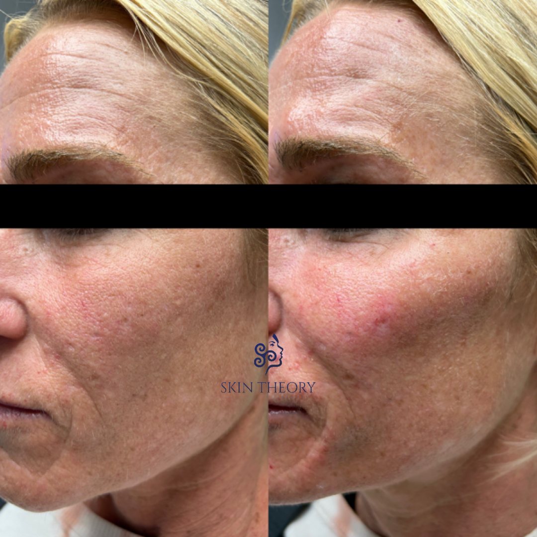 Skin-and-Derm Theory-Before-and-after-Radiesse-for-cheeks-March-2024-1