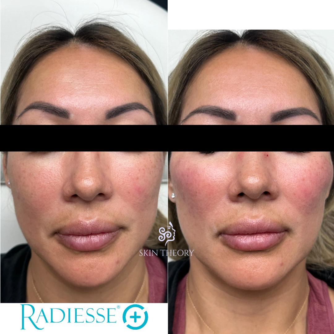 Skin-and-Derm Theory-Before-and-after-Radiesse-for-cheeks-March-2024-3