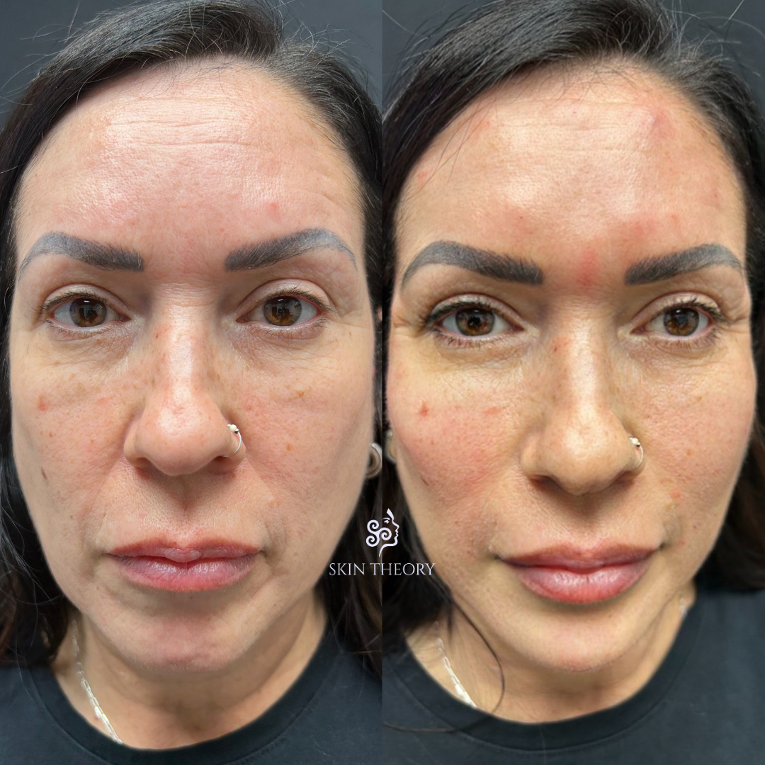 Skin-and-Derm Theory-Before-and-after-Radiesse-for-cheeks-and-laugh-lines-April-2024