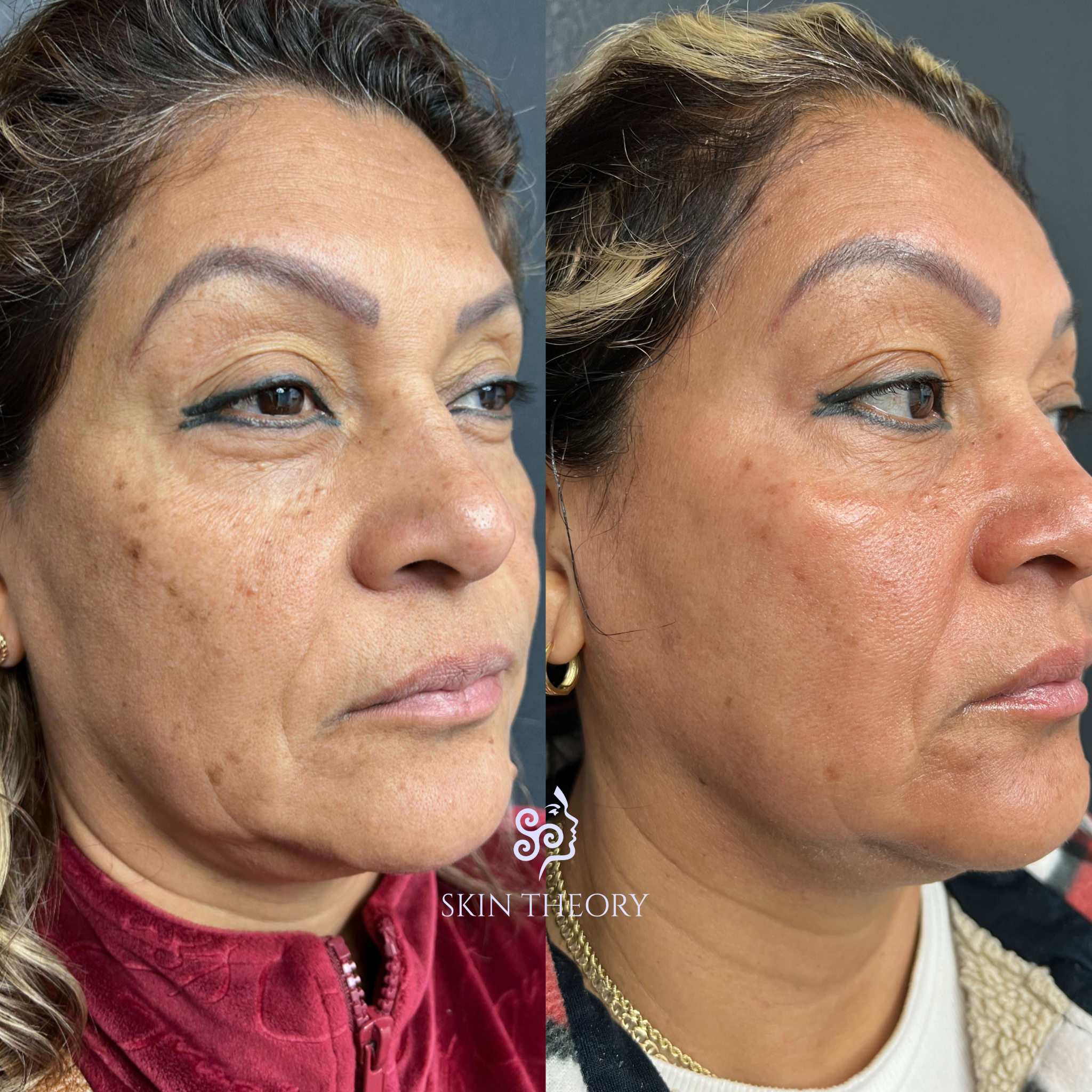 Skin and Derm Theory-LaseMD Ultra and Pigment Control Kit Before and After-202402-