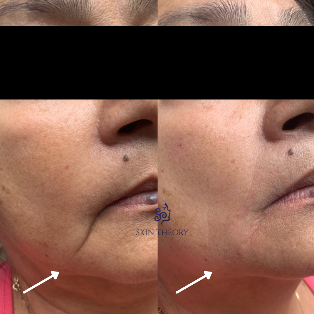 Skin and Derm Theory-RHA Filler Before and After-202401-1