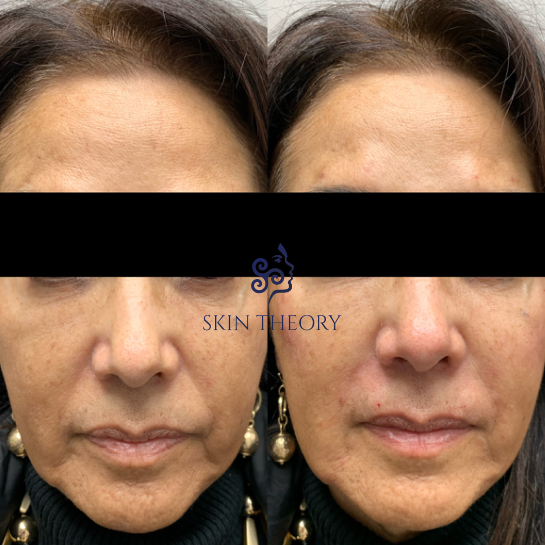 Skin and Derm Theory-RHA Filler Before and After-202401-2