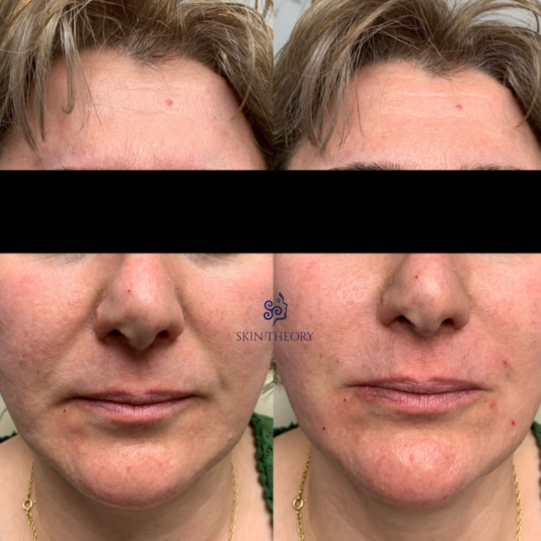 Skin and Derm Theory-RHA Filler Before and After-202401-3