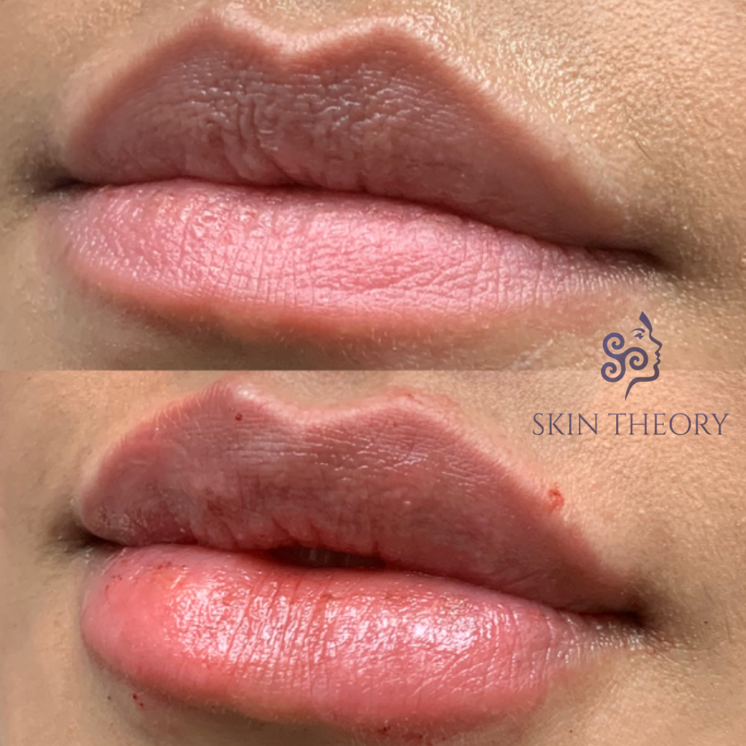 Skin and Derm Theory-RHA Lip Filler Before and After-202401-1