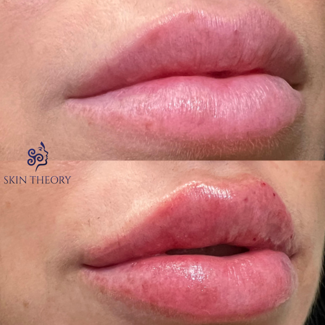 Skin and Derm Theory-RHA Lip Filler Before and After-202401-2