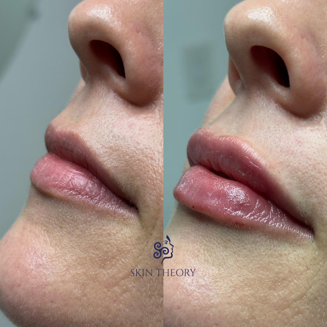 Skin and Derm Theory-RHA Lip Filler Before and After-202402-1