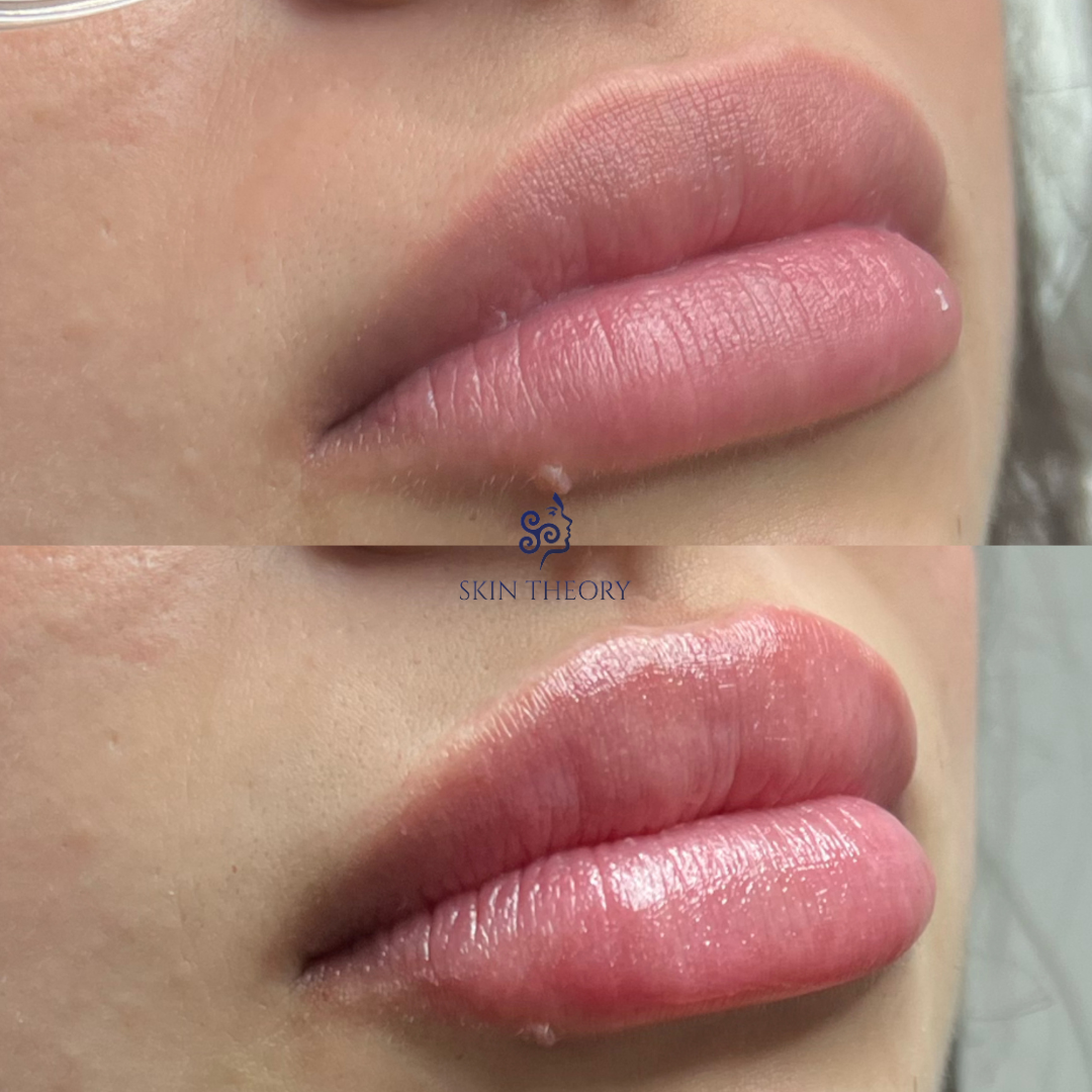 Skin and Derm Theory-RHA Lip Filler Before and After-202402-2