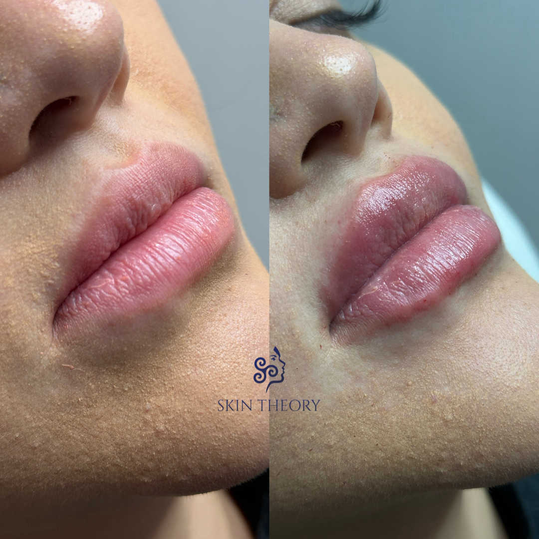 Skin and Derm Theory-RHA Lip Filler Before and After-202402-3