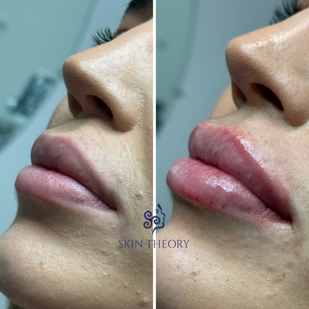 Skin and Derm Theory-RHA Lip Filler Before and After-202402-4