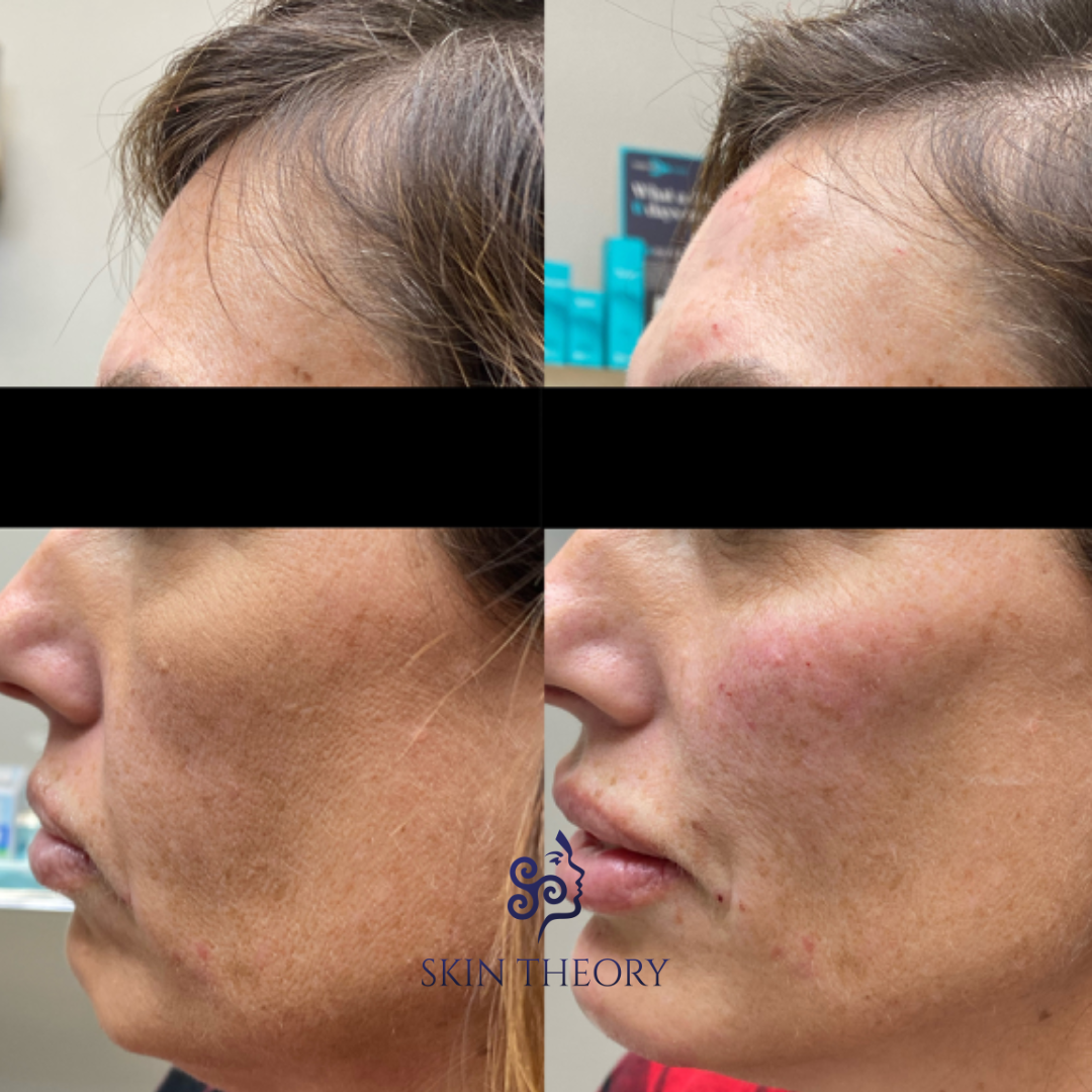 Skin and Derm Theory-Radiesse Filler Before and After-202401-1