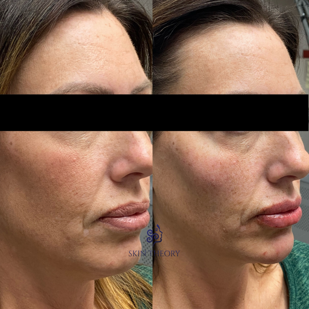 Skin and Derm Theory-Radiesse Filler Before and After-202401-2