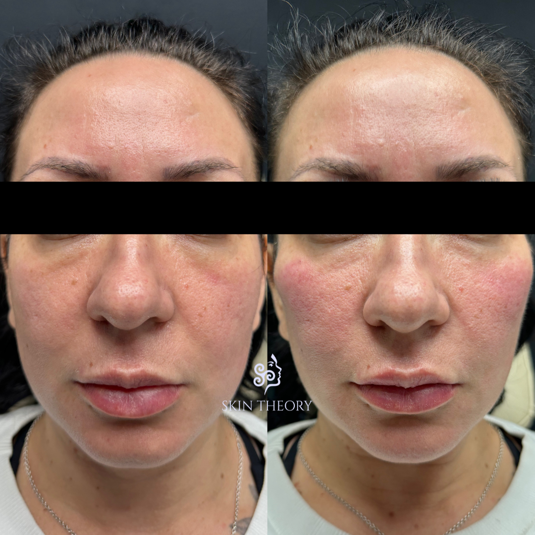 Skin and Derm Theory-Radiesse Filler Before and After-202402-1