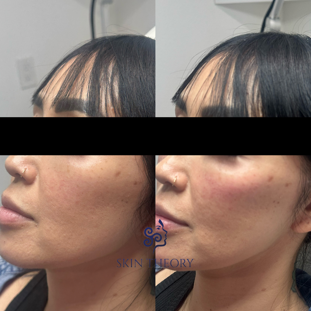 Skin and Derm Theory-Radiesse Filler Before and After-202402-2