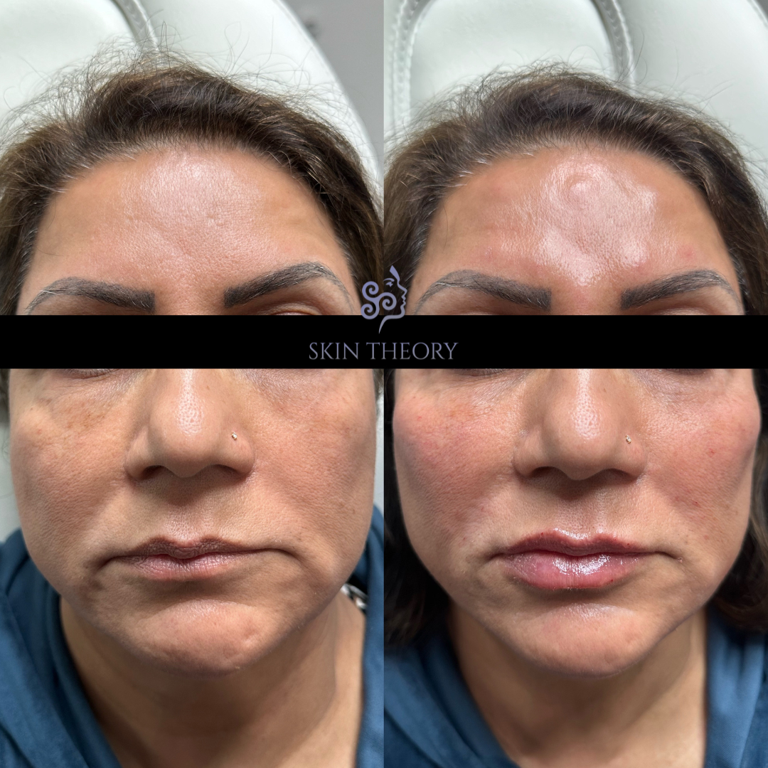 Skin and Derm Theory-Radiesse Filler Before and After-202402-3