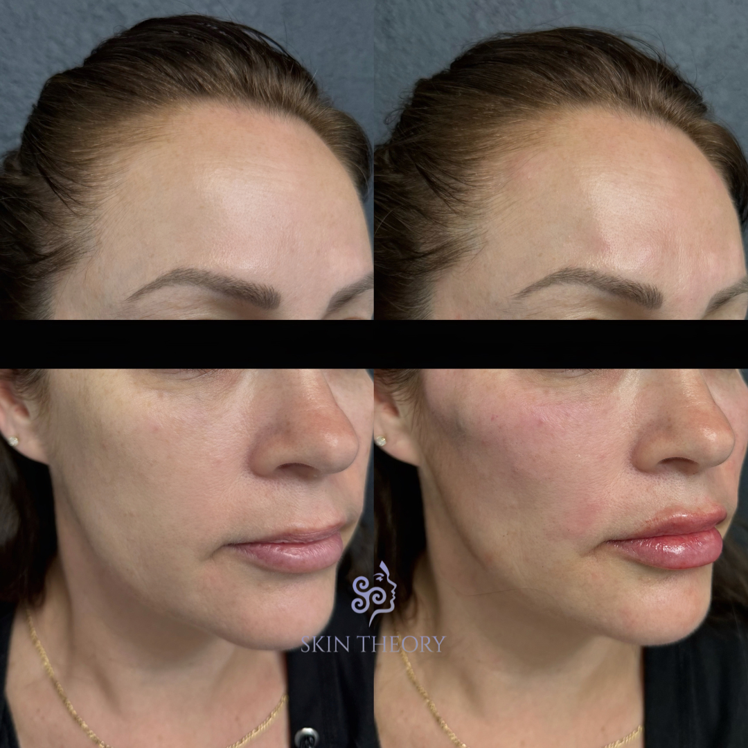 Skin and Derm Theory-Radiesse Filler Before and After-202402-4