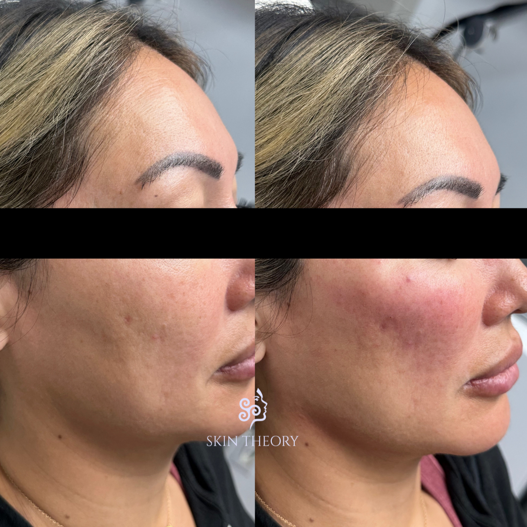 Skin and Derm Theory-Radiesse Filler Before and After-202402-5