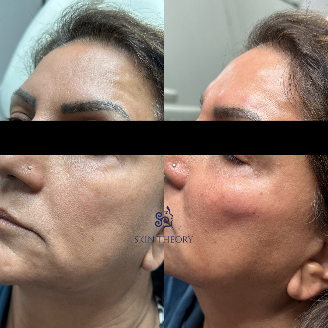 Skin and Derm Theory-Radiesse Filler Before and After-202402-6