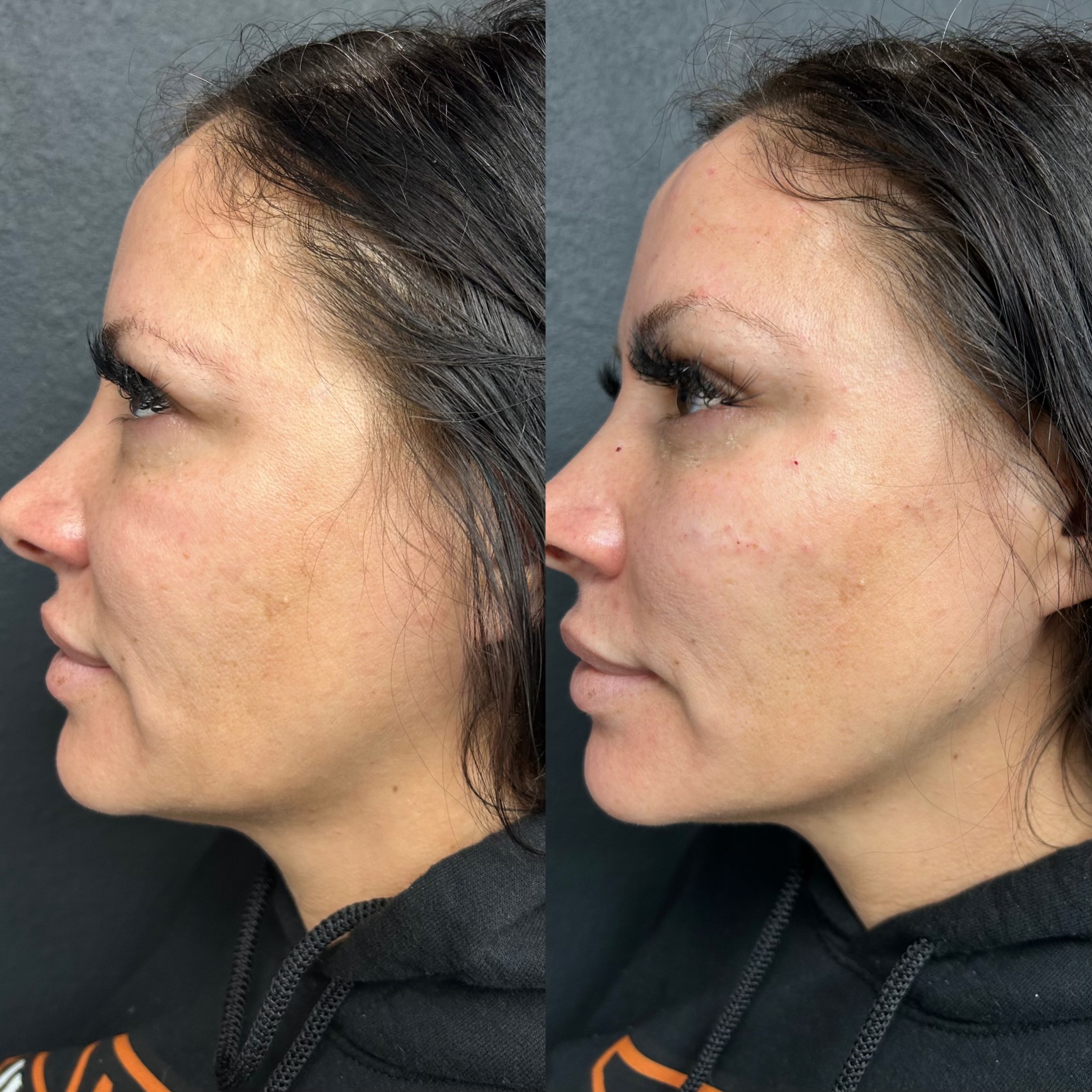 Skin and Derm Theory-Radiesse Filler Before and After-202402-7