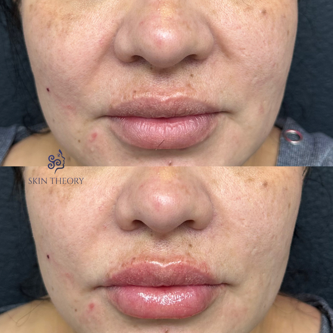 rha for pyriform and lips